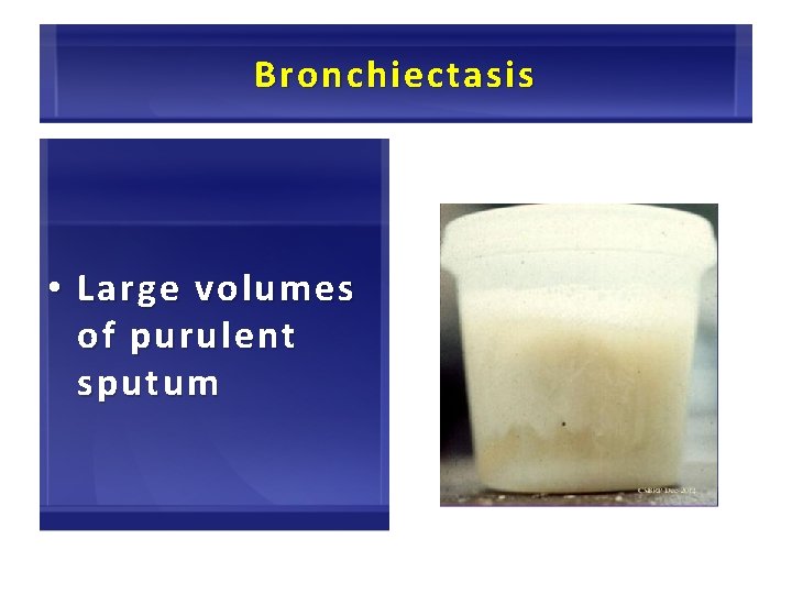 Bronchiectasis • Large volumes of purulent sputum 45 