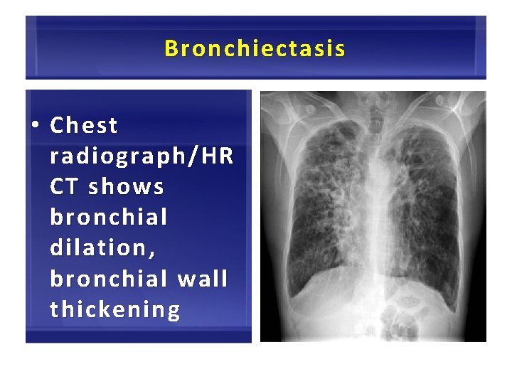 Bronchiectasis • Chest radiograph/HR CT shows bronchial dilation , bronchial wall thickening 48 