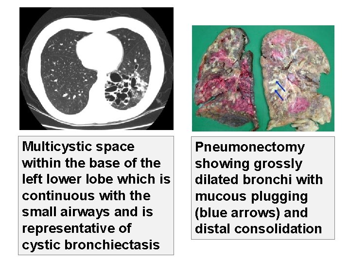 49 Multicystic space within the base of the left lower lobe which is continuous