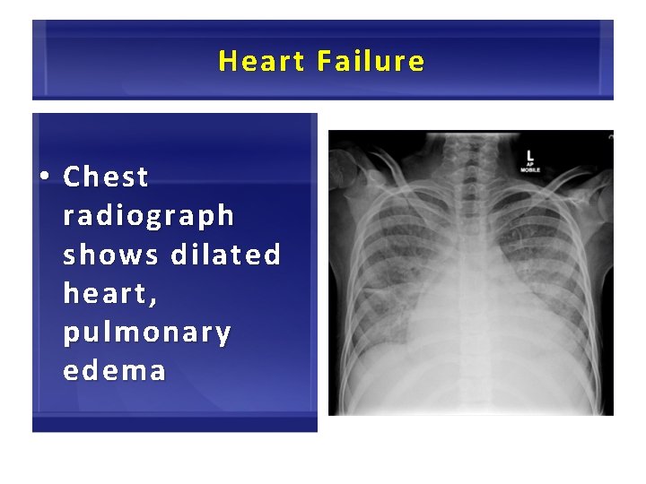 Heart Failure • Chest radiograph shows dilated heart, pulmonary edema 52 