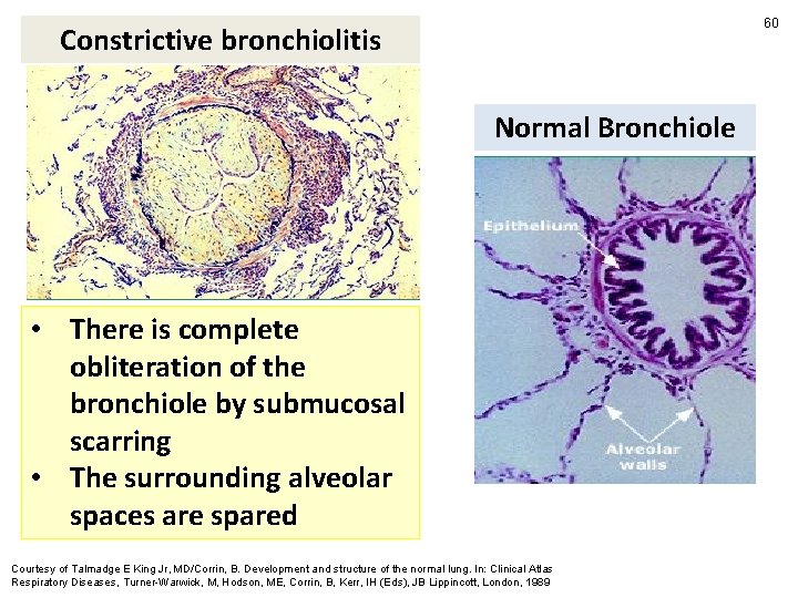 60 Constrictive bronchiolitis Normal Bronchiole • There is complete obliteration of the bronchiole by
