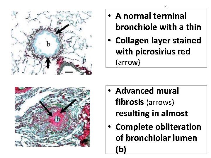 61 • A normal terminal bronchiole with a thin • Collagen layer stained with