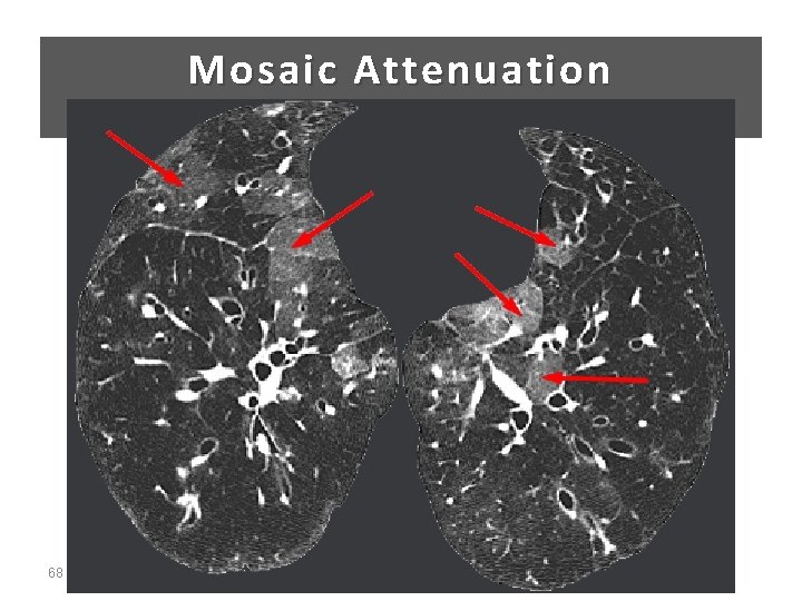 Mosaic Attenuation 68 