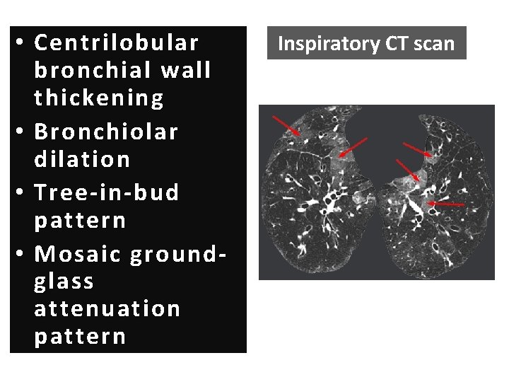  • Centrilobular bronchial wall thickening • Bronchiolar dilation • Tree-in-bud pattern • Mosaic