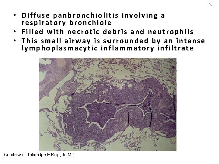 75 • Diffuse panbronchiolitis involving a respiratory bronchiole • Filled with necrotic debris and