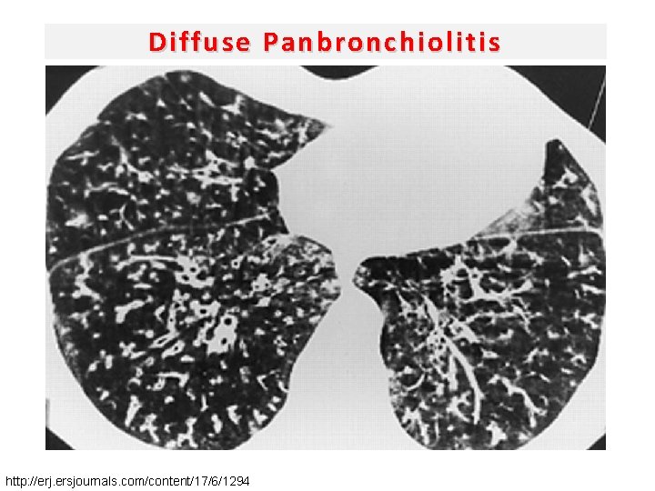 Diffuse Panbronchiolitis http: //erj. ersjournals. com/content/17/6/1294 