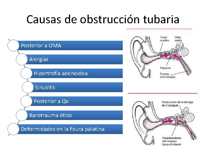 Causas de obstrucción tubaria Posterior a OMA Alergias Hipertrofia adenoidea Sinusitis Posterior a Qx