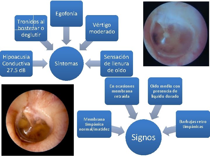 Egofonía Tronidos al bostezar o deglutir Hipoacusia Conductiva 27. 5 d. B Vértigo moderado