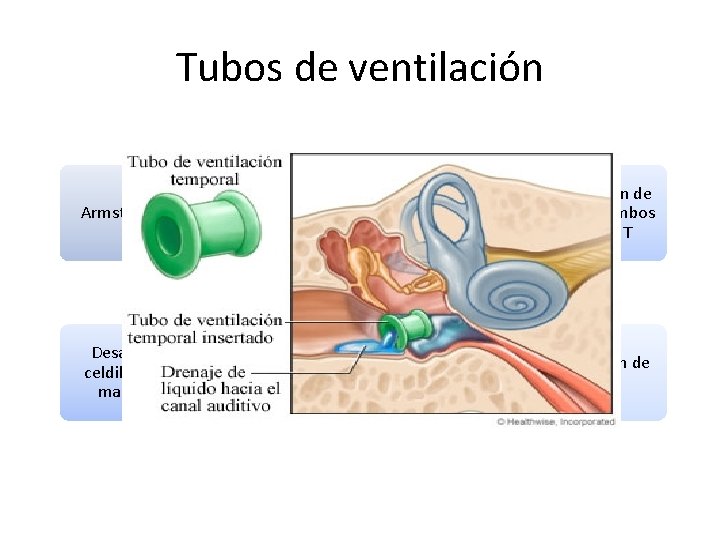 Tubos de ventilación Armstrong 1954 Cuadranterosuperior Compensación de presiones a ambos lados de MT