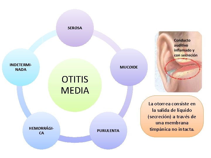 SEROSA INDETERMINADA MUCOIDE OTITIS MEDIA HEMORRÁGICA PURULENTA La otorrea consiste en la salida de