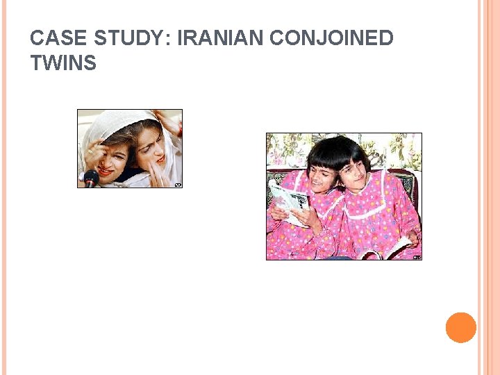 CASE STUDY: IRANIAN CONJOINED TWINS 