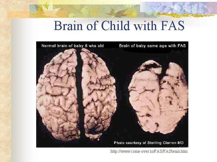 Brain of Child with FAS http: //www. come-over. to/FASbrain. htm 