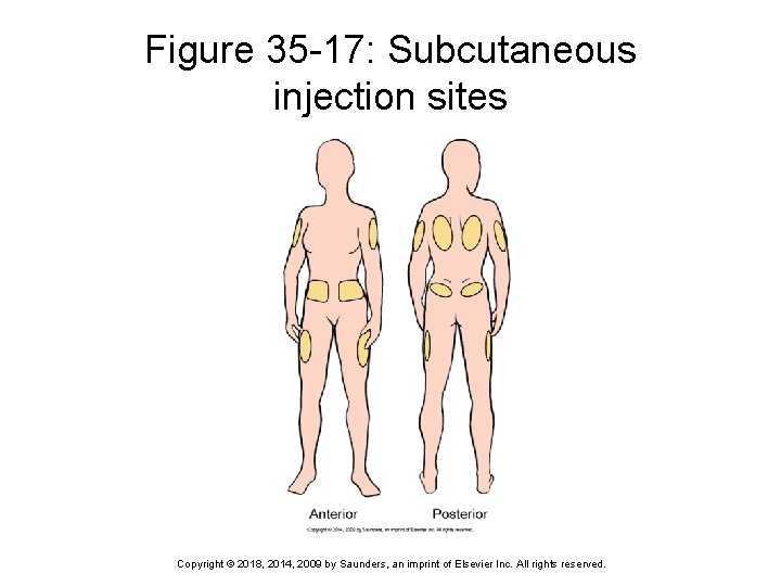 Figure 35 -17: Subcutaneous injection sites Copyright © 2018, 2014, 2009 by Saunders, an