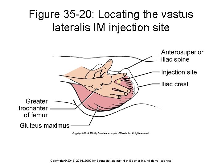 Figure 35 -20: Locating the vastus lateralis IM injection site Copyright © 2018, 2014,