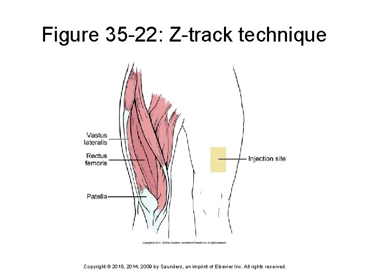 Figure 35 -22: Z-track technique Copyright © 2018, 2014, 2009 by Saunders, an imprint