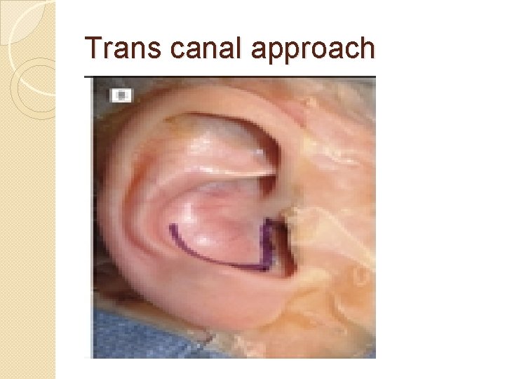 Trans canal approach 