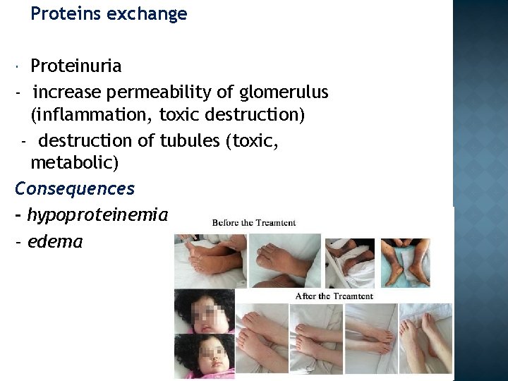 Proteins exchange Proteinuria - increase permeability of glomerulus (inflammation, toxic destruction) - destruction of