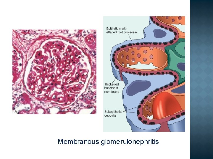 Membranous glomerulonephritis 