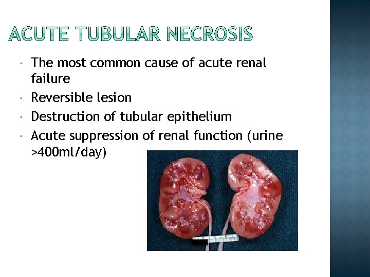  The most common cause of acute renal failure Reversible lesion Destruction of tubular