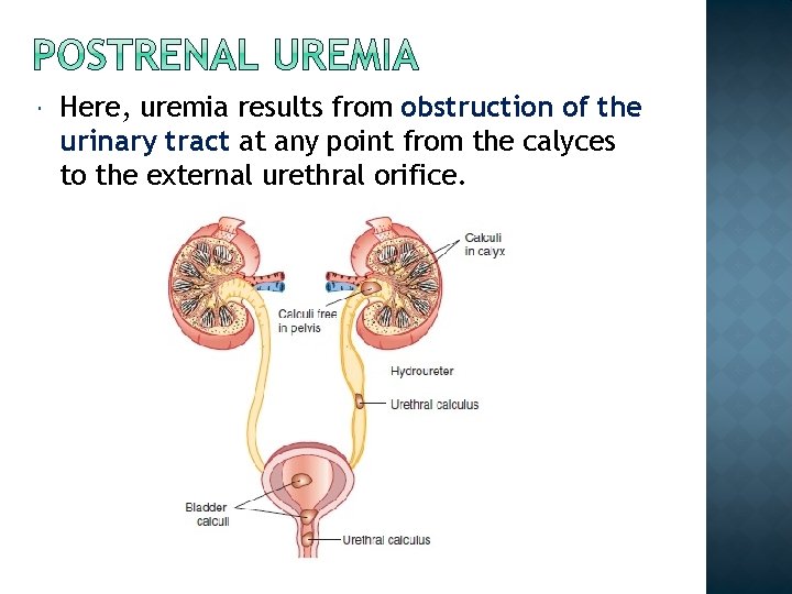  Here, uremia results from obstruction of the urinary tract at any point from