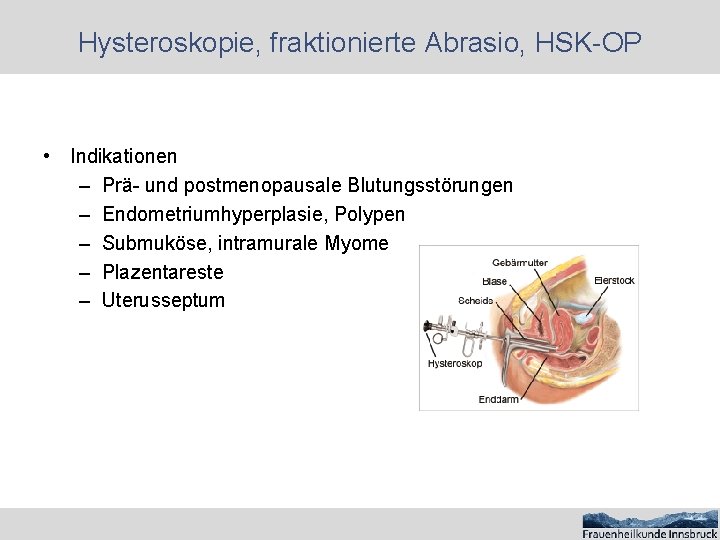 Hysteroskopie, fraktionierte Abrasio, HSK-OP • Indikationen – Prä- und postmenopausale Blutungsstörungen – Endometriumhyperplasie, Polypen