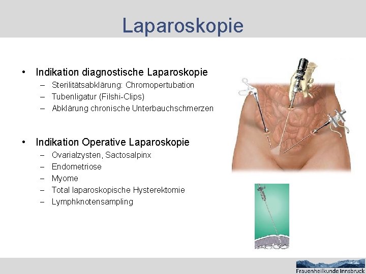 Laparoskopie • Indikation diagnostische Laparoskopie – Sterilitätsabklärung: Chromopertubation – Tubenligatur (Filshi-Clips) – Abklärung chronische