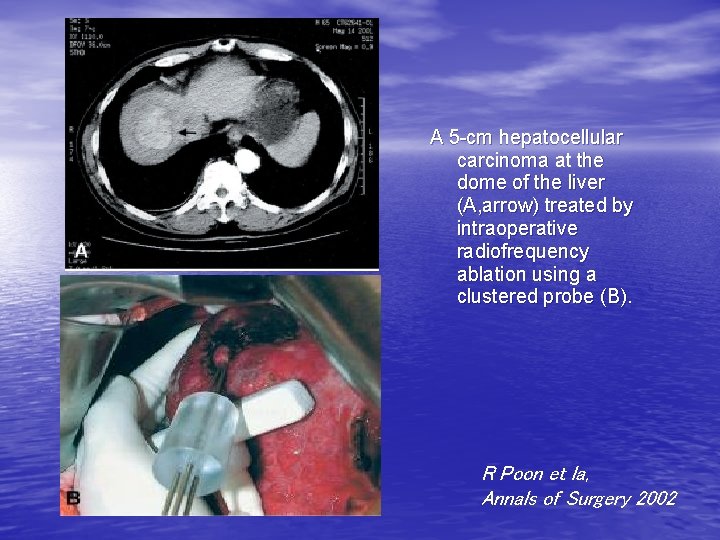 A 5 -cm hepatocellular carcinoma at the dome of the liver (A, arrow) treated