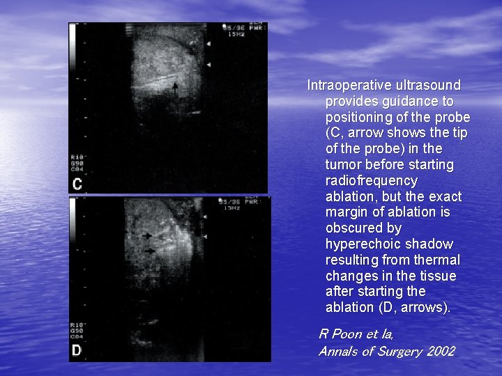 Intraoperative ultrasound provides guidance to positioning of the probe (C, arrow shows the tip