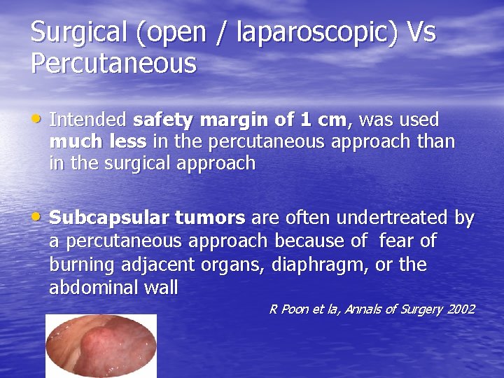 Surgical (open / laparoscopic) Vs Percutaneous • Intended safety margin of 1 cm, was