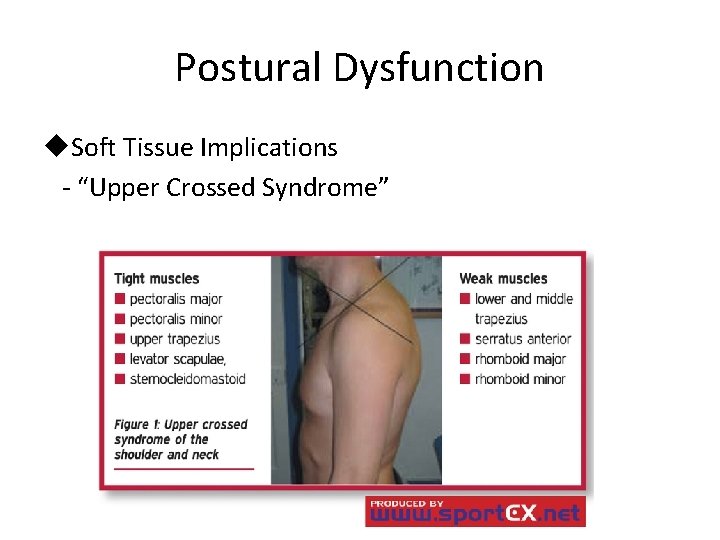 Postural Dysfunction u. Soft Tissue Implications - “Upper Crossed Syndrome” 