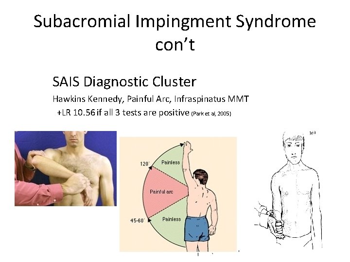Subacromial Impingment Syndrome con’t SAIS Diagnostic Cluster Hawkins Kennedy, Painful Arc, Infraspinatus MMT +LR