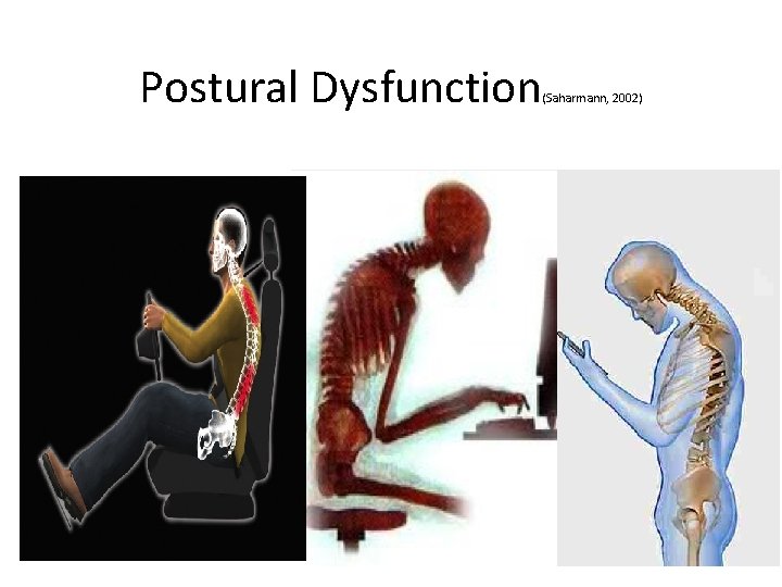 Postural Dysfunction (Saharmann, 2002) 