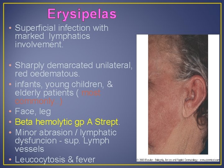 Erysipelas • Superficial infection with marked lymphatics involvement. • Sharply demarcated unilateral, red oedematous.
