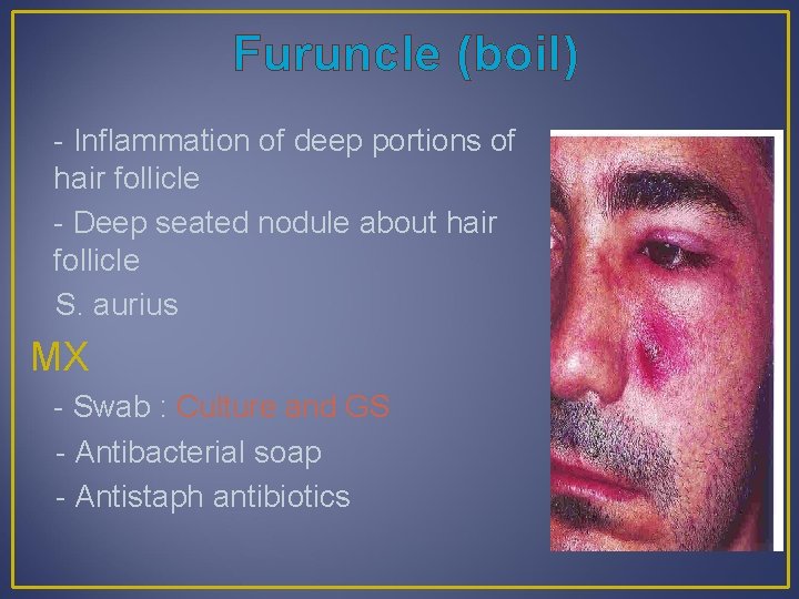 Furuncle (boil) - Inflammation of deep portions of hair follicle - Deep seated nodule