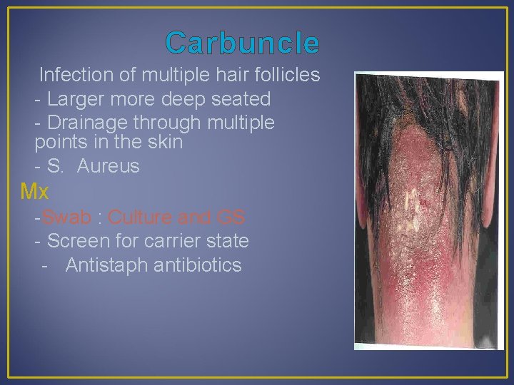 Carbuncle Infection of multiple hair follicles - Larger more deep seated - Drainage through