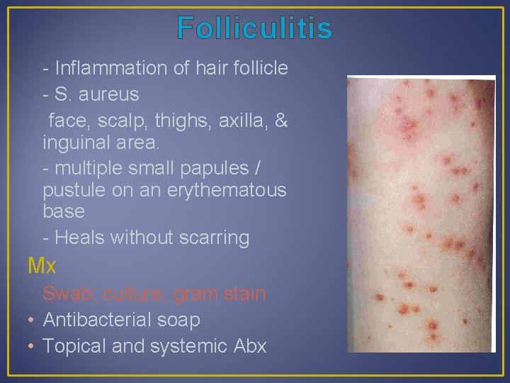 Folliculitis - Inflammation of hair follicle - S. aureus face, scalp, thighs, axilla, &