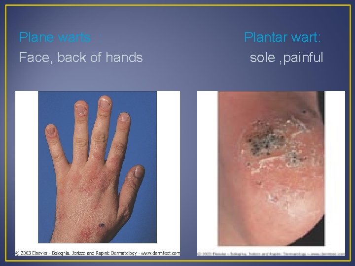 Plane warts : Face, back of hands Plantar wart: sole , painful 