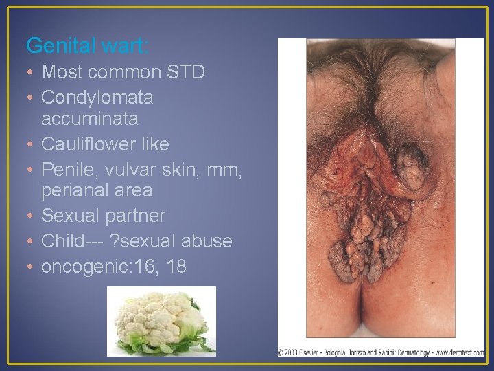 Genital wart: • Most common STD • Condylomata accuminata • Cauliflower like • Penile,