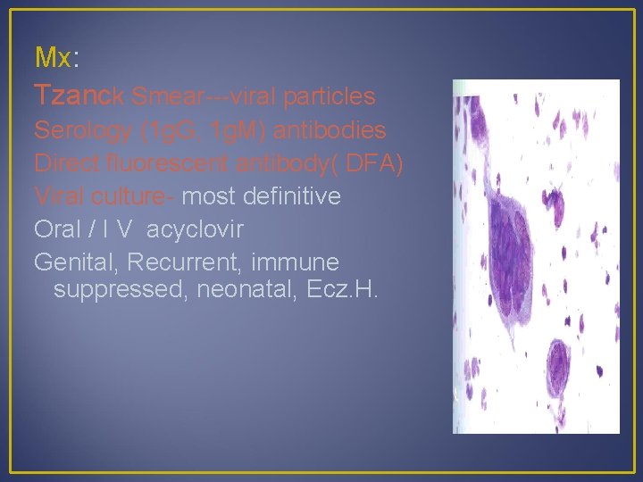 Mx: Tzanck Smear---viral particles Serology (1 g. G, 1 g. M) antibodies Direct fluorescent