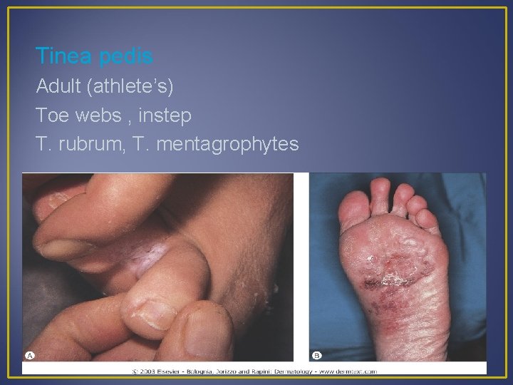 Tinea pedis Adult (athlete’s) Toe webs , instep T. rubrum, T. mentagrophytes 