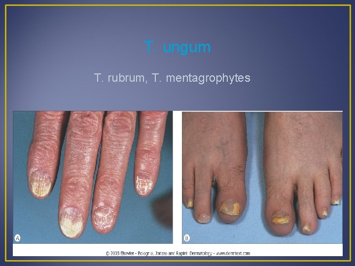 T. ungum T. rubrum, T. mentagrophytes 