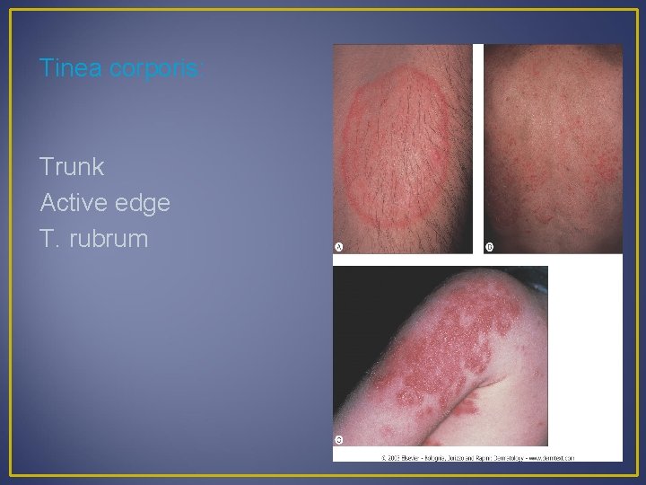 Tinea corporis: Trunk Active edge T. rubrum 