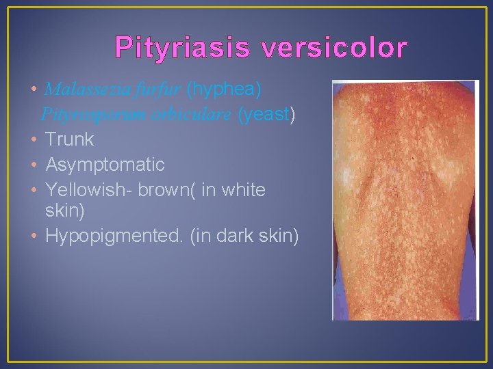 Pityriasis versicolor • Malassezia furfur (hyphea) Pityrosporum orbiculare (yeast) • Trunk • Asymptomatic •
