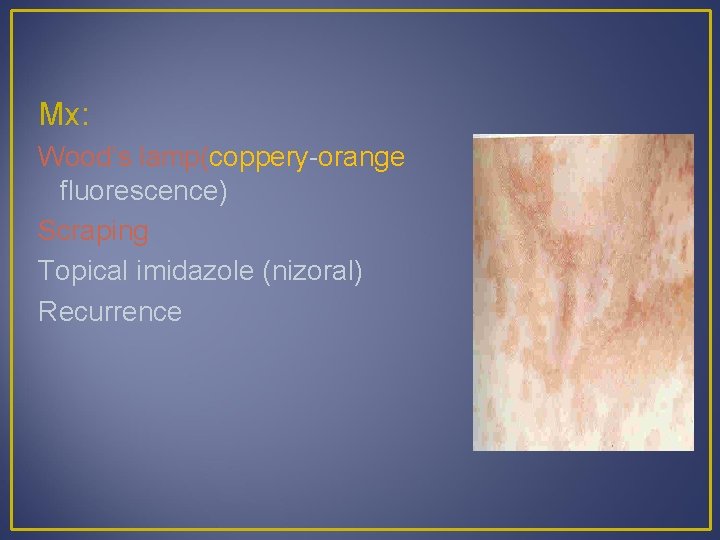 Mx: Wood’s lamp(coppery-orange fluorescence) Scraping Topical imidazole (nizoral) Recurrence 