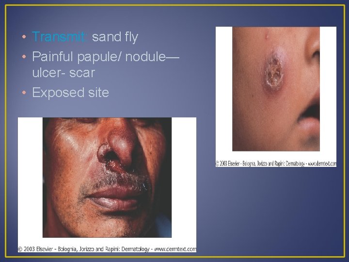  • Transmit: sand fly • Painful papule/ nodule— ulcer- scar • Exposed site
