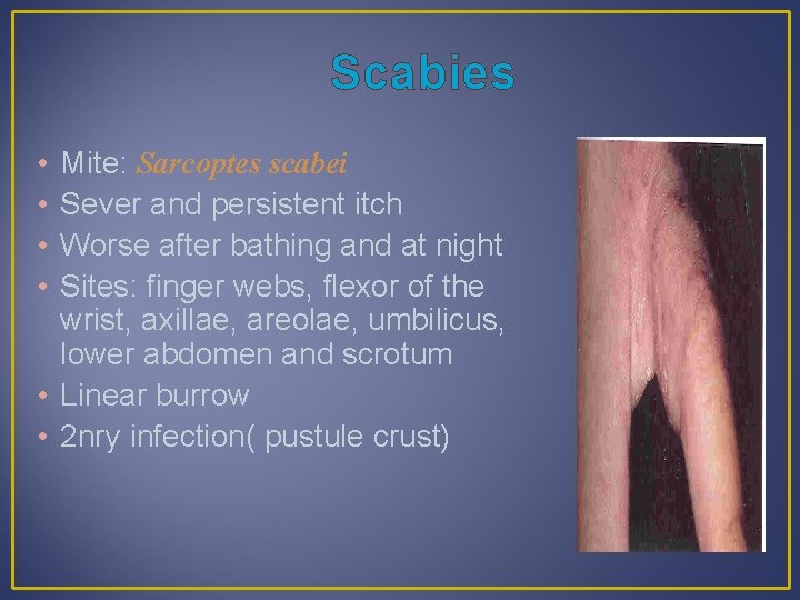 Scabies • • Mite: Sarcoptes scabei Sever and persistent itch Worse after bathing and