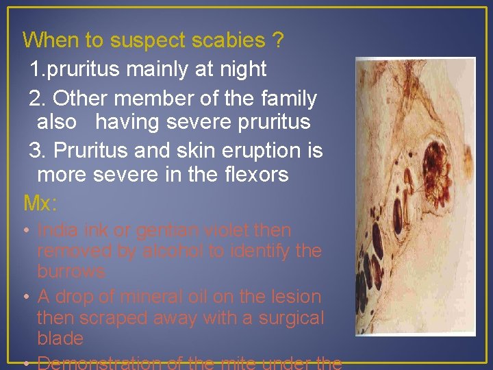 When to suspect scabies ? 1. pruritus mainly at night 2. Other member of