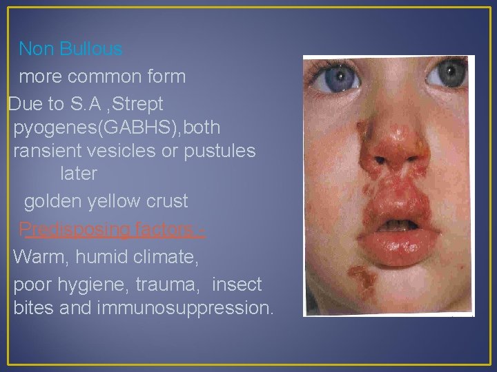 Non Bullous more common form Due to S. A , Strept pyogenes(GABHS), both ransient