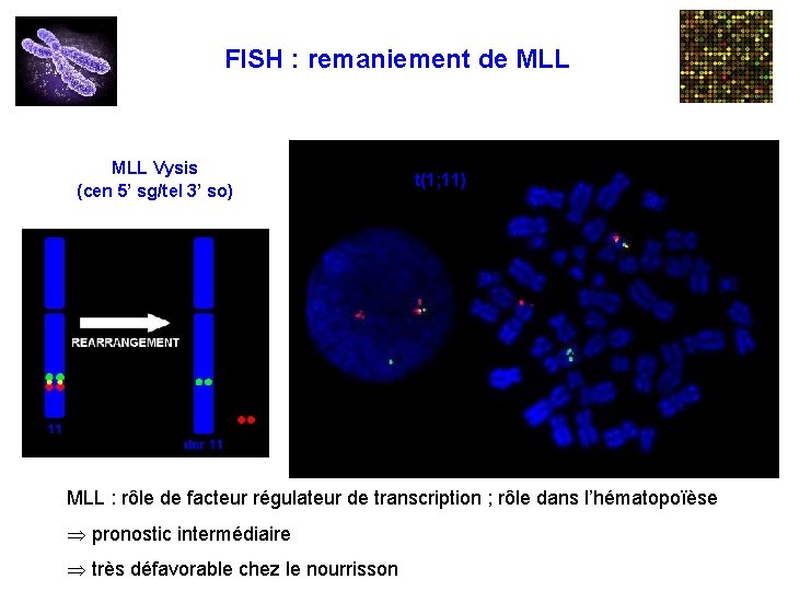 FISH : remaniement de MLL Vysis (cen 5’ sg/tel 3’ so) t(1; 11) MLL