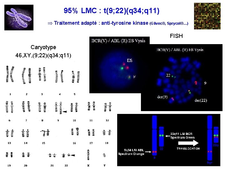 95% LMC : t(9; 22)(q 34; q 11) Þ Traitement adapté : anti-tyrosine kinase